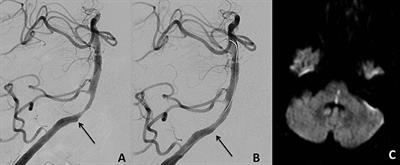 Angioplasty and Stenting of Intracranial Arterial Stenosis in Perforator-Bearing Segments: A Comparison Between the Anterior and the Posterior Circulation